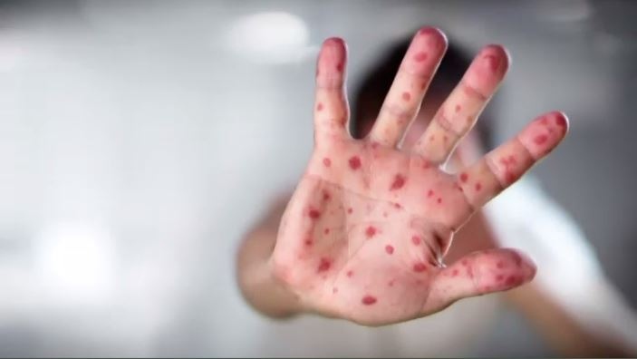 Measles in Toronto: 2nd case confirmed [Video]