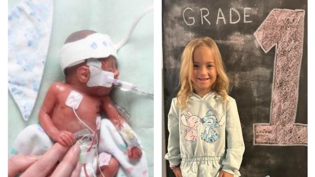 She weighed less than 500 grams at birth. This P.E.I. micro-preemie is now 6 and thriving [Video]