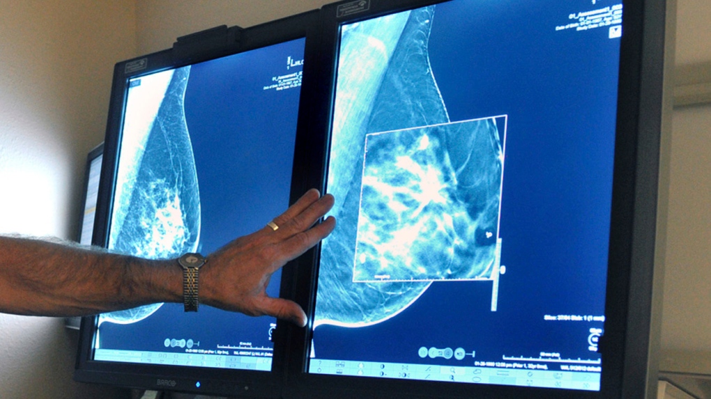 Ontario lowers the age for self-referral mammogram breast screening to age 40 [Video]