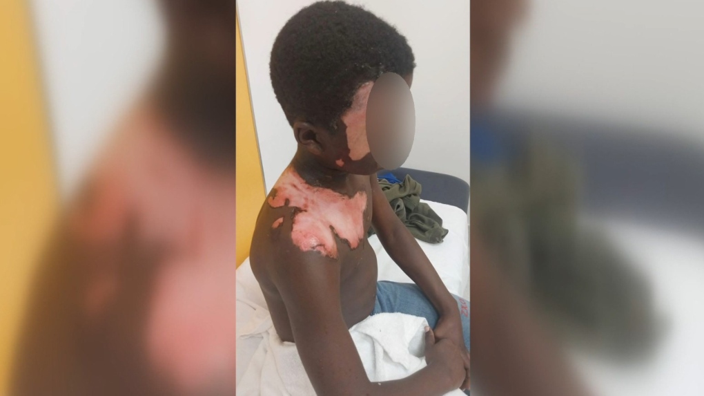 Longueuil boy scalded after neighbour allegedly pours boiling water on him [Video]