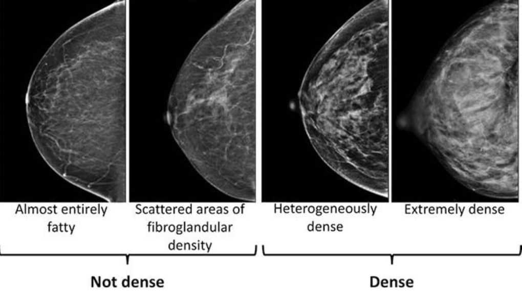 Mammogram complications: Dense breasts make cancer hard to spot [Video]