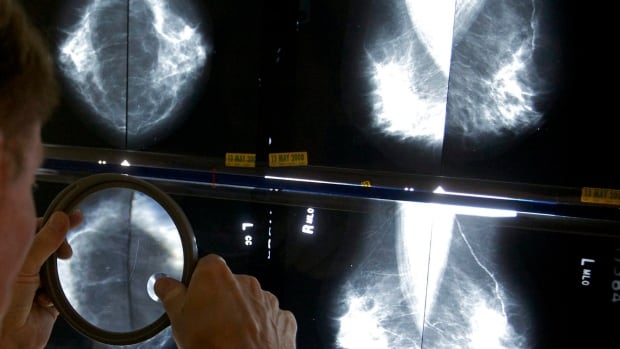 Women falling through the cracks as N.L. lags on breast screening changes, advocate says [Video]