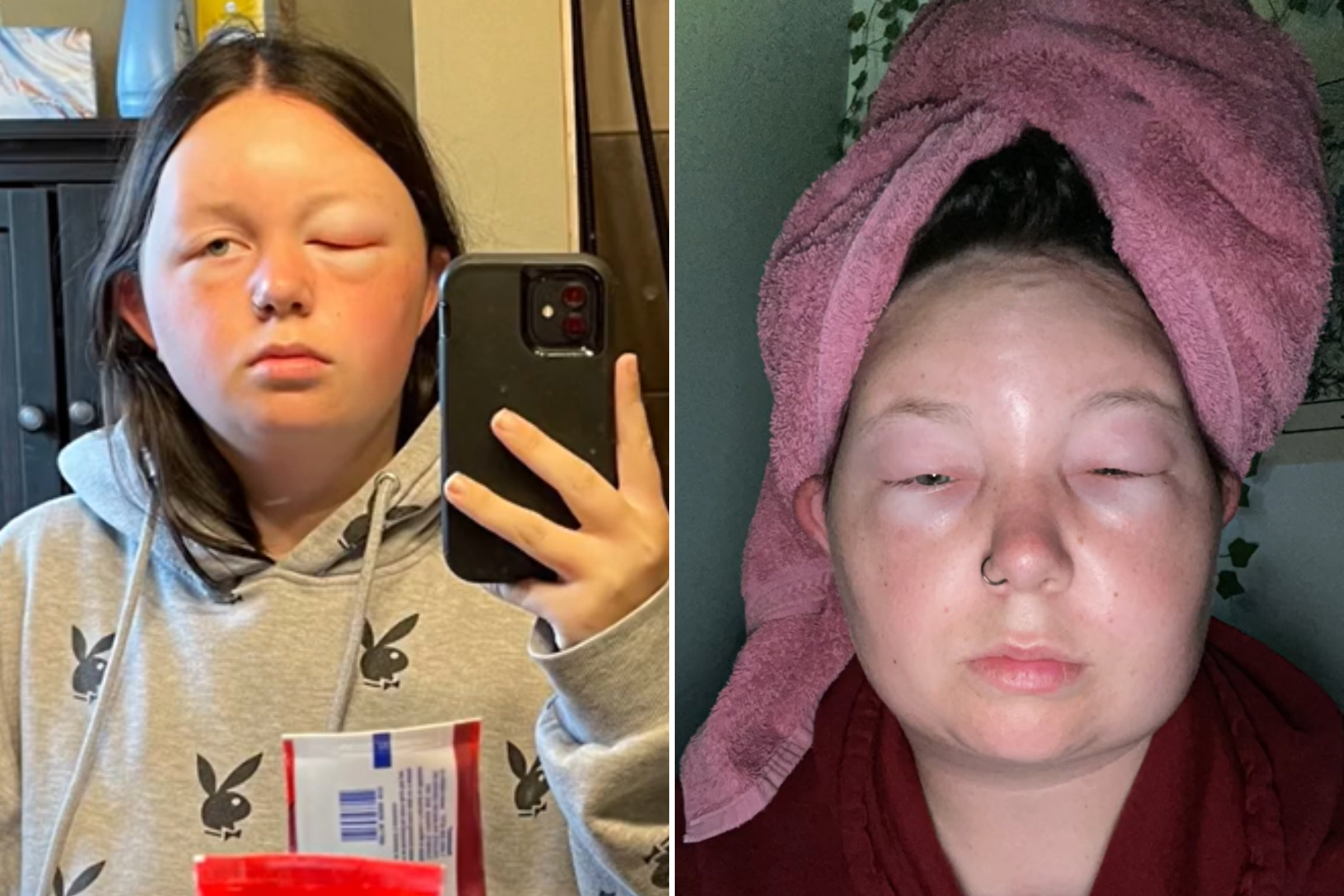 Woman Suffers Shock Allergic Reaction to Box Hair Dye: ‘Never Again’ [Video]