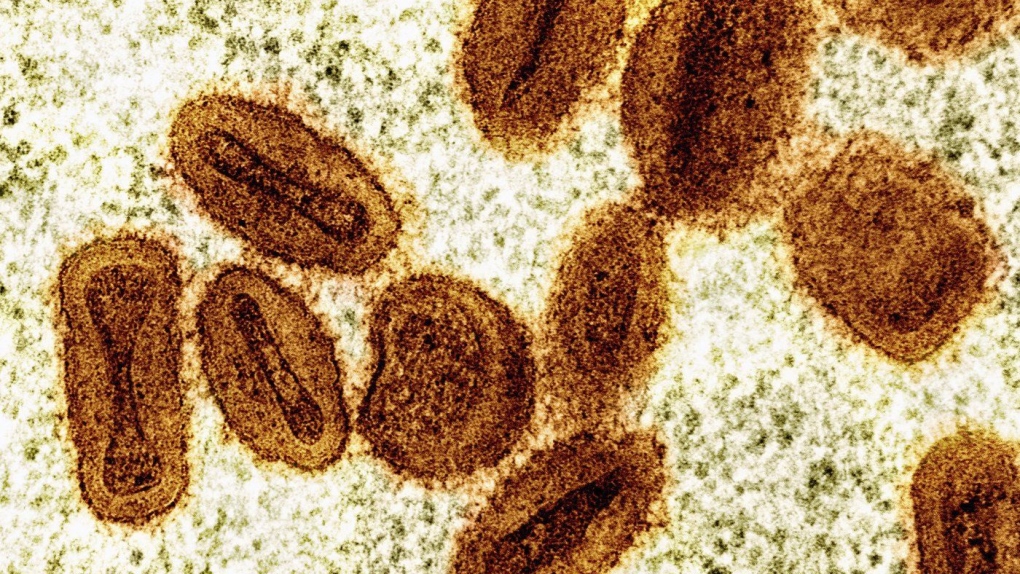 Mpox virus: United States confirms first case, in a traveler [Video]