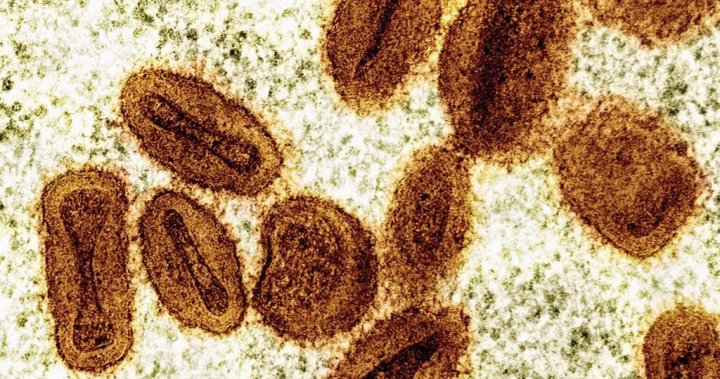 1st U.S. case of severe mpox strain confirmed in traveller: health officials – National [Video]