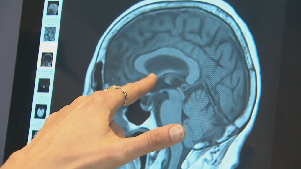 Waterloo company says it can detect concussions through saliva [Video]