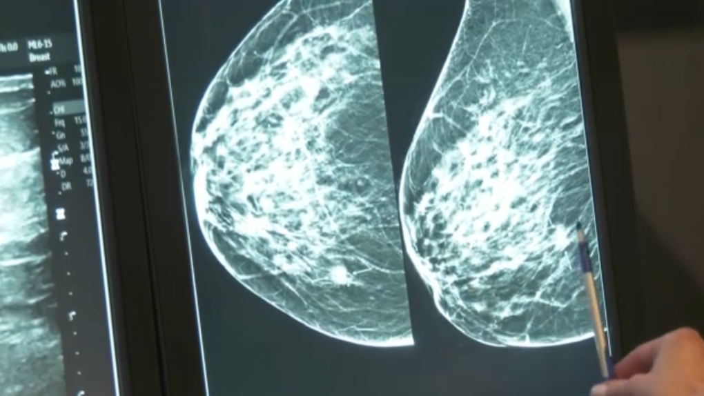 Mammograms in Claresholm: mobile service coming in Dec [Video]