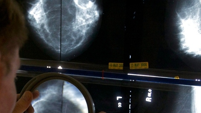 Saskatchewan to lower breast cancer screening eligibility on Jan. 1 [Video]