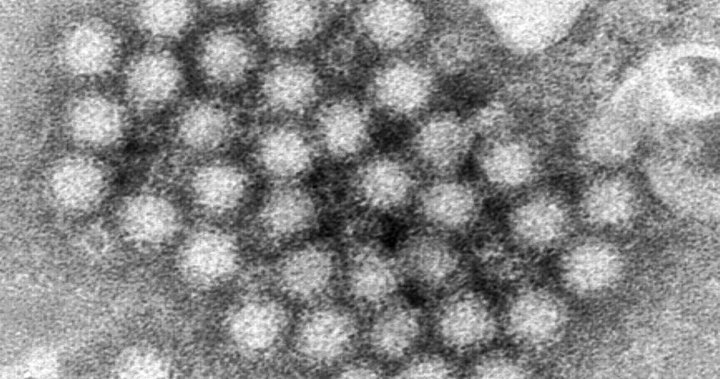 Norovirus is surging in the U.S. this winter compared to past years: CDC - National [Video]