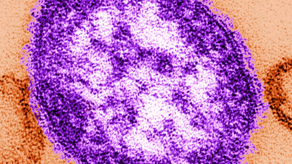 Quebec confirms measles outbreak in Montreal, Laval and Laurentians [Video]