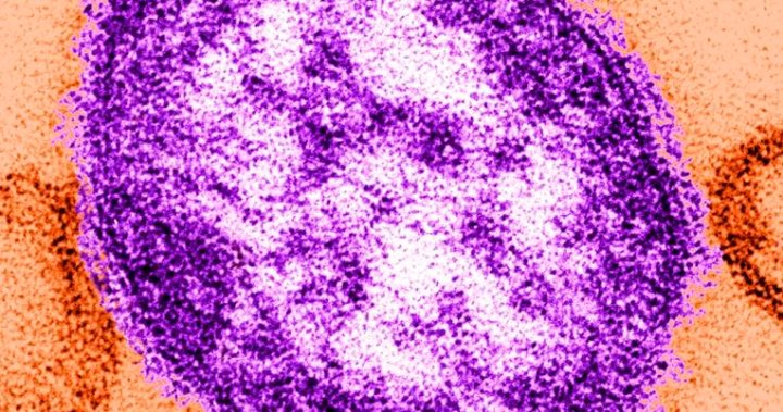 New Brunswick declares end to measles outbreak that spread to 50 people – New Brunswick [Video]