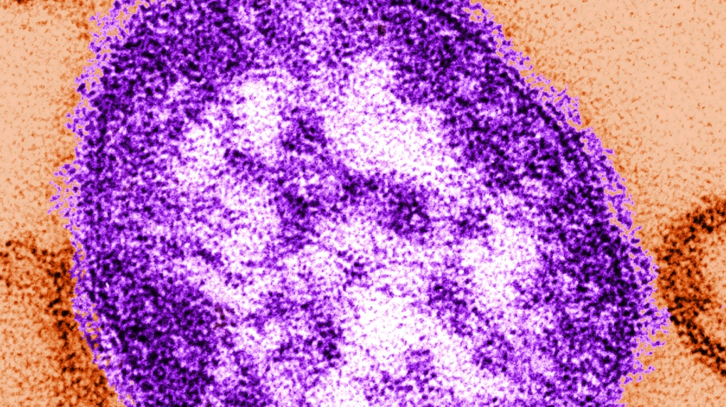 Quebec measles outbreak grows to 11 cases; officials warn of thousands of exposures [Video]