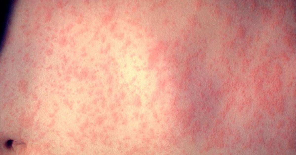 Measles outbreak declared by Grand Erie health unit [Video]