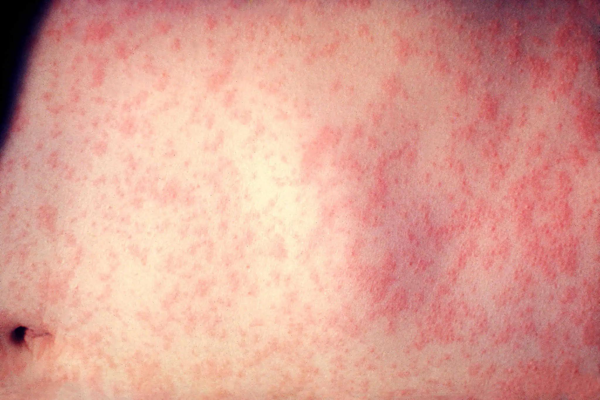 Measles outbreaks in Ontario and other parts of Canada raise alarm [Video]