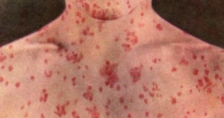 Rapidly increasing: Ontario communities engulfed with measles cases declare outbreak [Video]