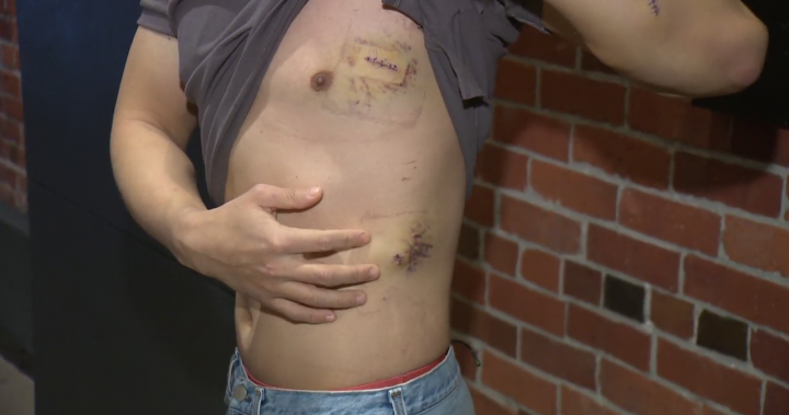 Unbelievable: Yaletown stabbing victim shocked alleged attacker back on the street - BC [Video]