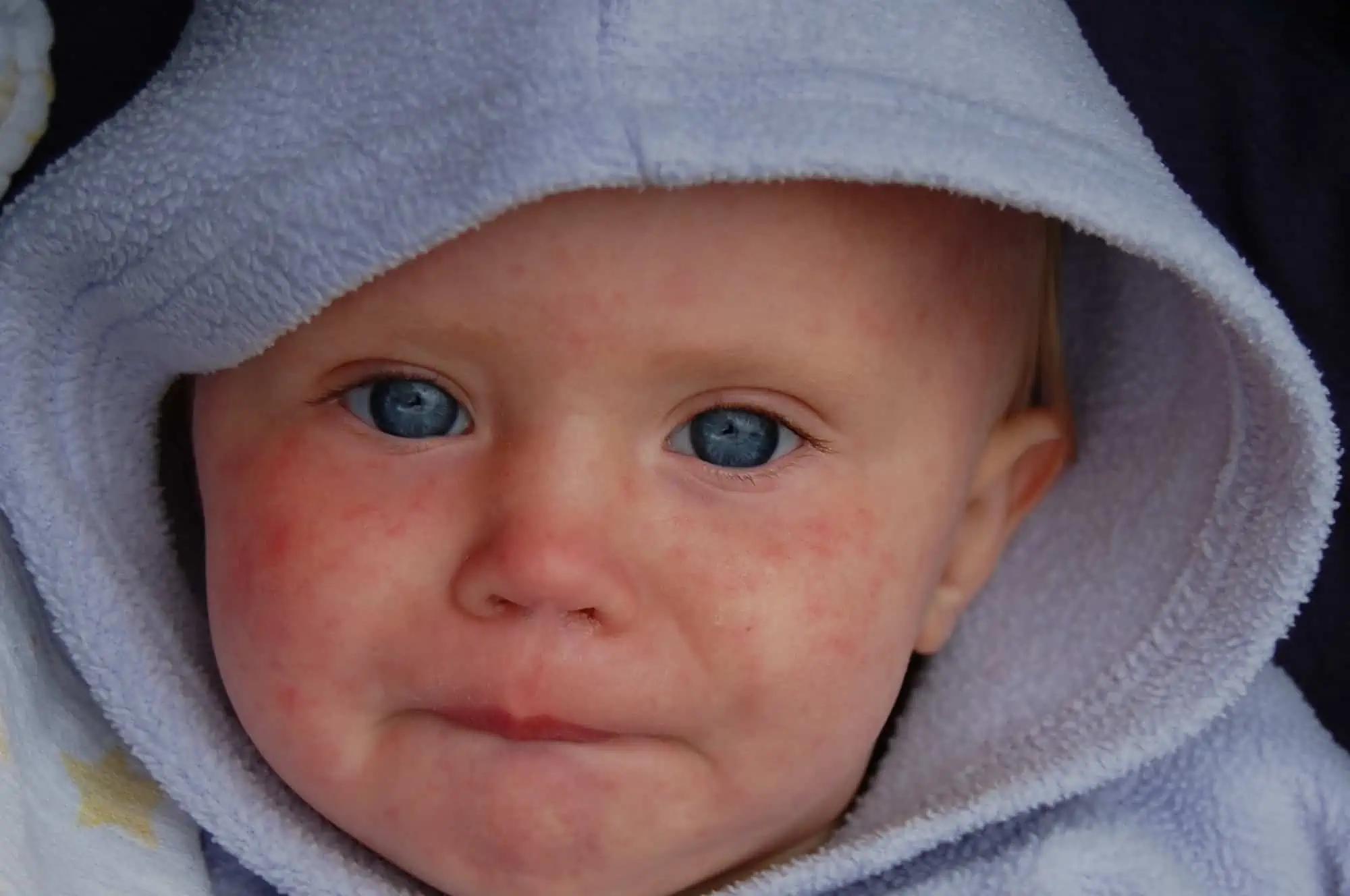 Measles exposure reported at hotel and recreation centre in Ontario town [Video]