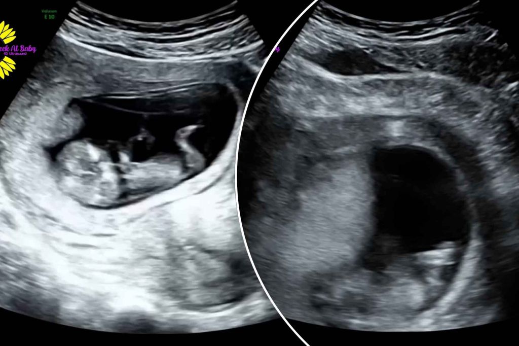 Ultrasound footage shows what happens when an expecting mother laughs during pregnancy (Video)