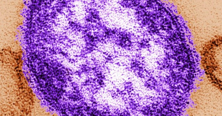 Second measles case confirmed in B.C.s Lower Mainland [Video]