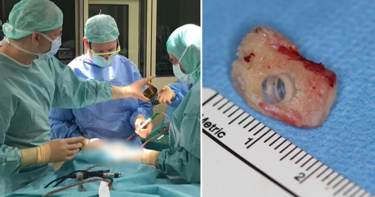 Man’s sight restored after his tooth is implanted in cheek then sewn into eye | News World [Video]