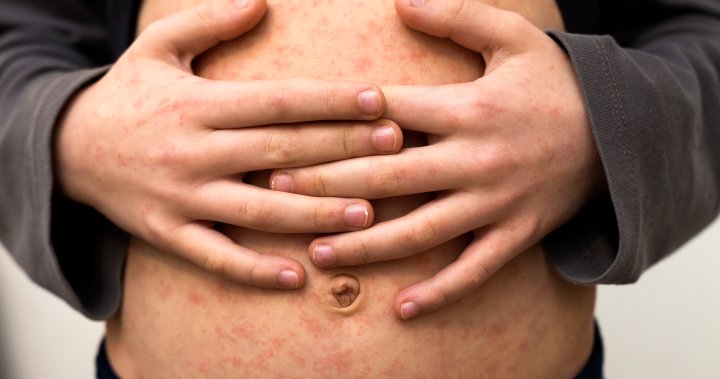 Parents are holding measles parties in the U.S., alarming health experts – National [Video]