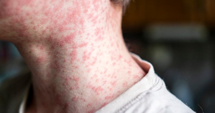 Ontario seeing massive spike in measles cases, officials warn of outbreak [Video]