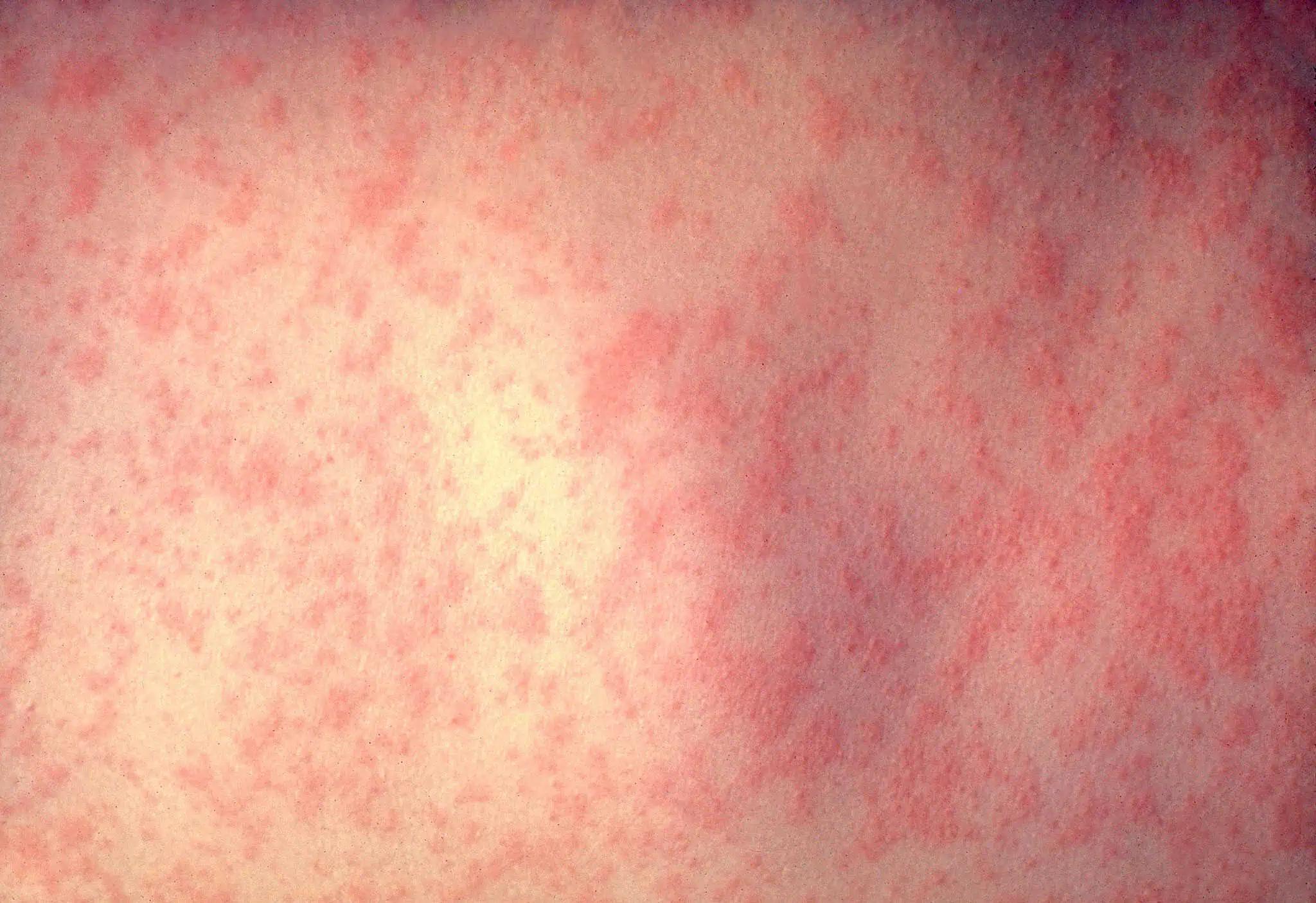 350 confirmed cases of the measles since 2024 in Ontario [Video]