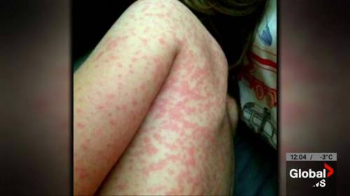 Public health alert in place in Edmonton over measles [Video]