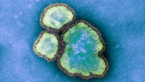 Almost 90 per cent of Ontario’s growing measles cases are in the southwest [Video]