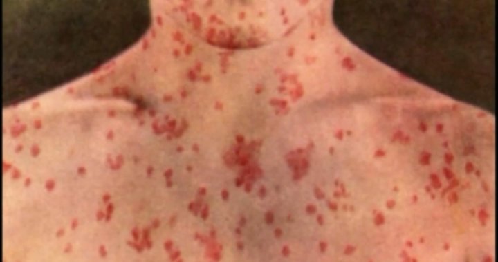 Alberta Health Services warns of new measles exposures in several communities [Video]