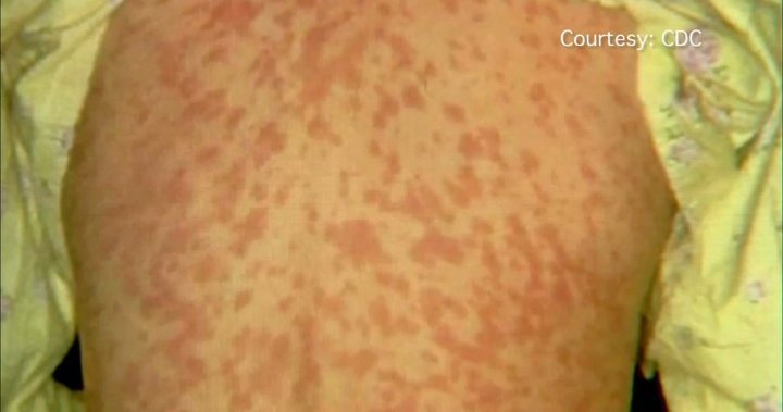 Measles advisory issued for Taber Health Centre [Video]