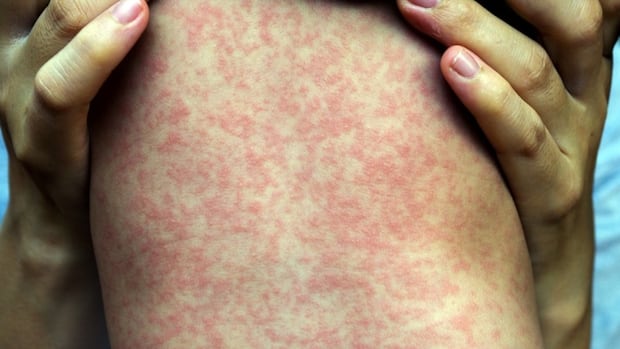 Do I need a third dose of the measles vaccine? And other common questions answered [Video]
