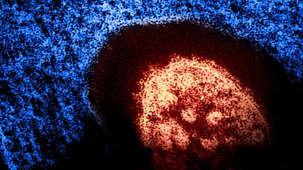 New measles case confirmed in B.C.’s Lower Mainland [Video]