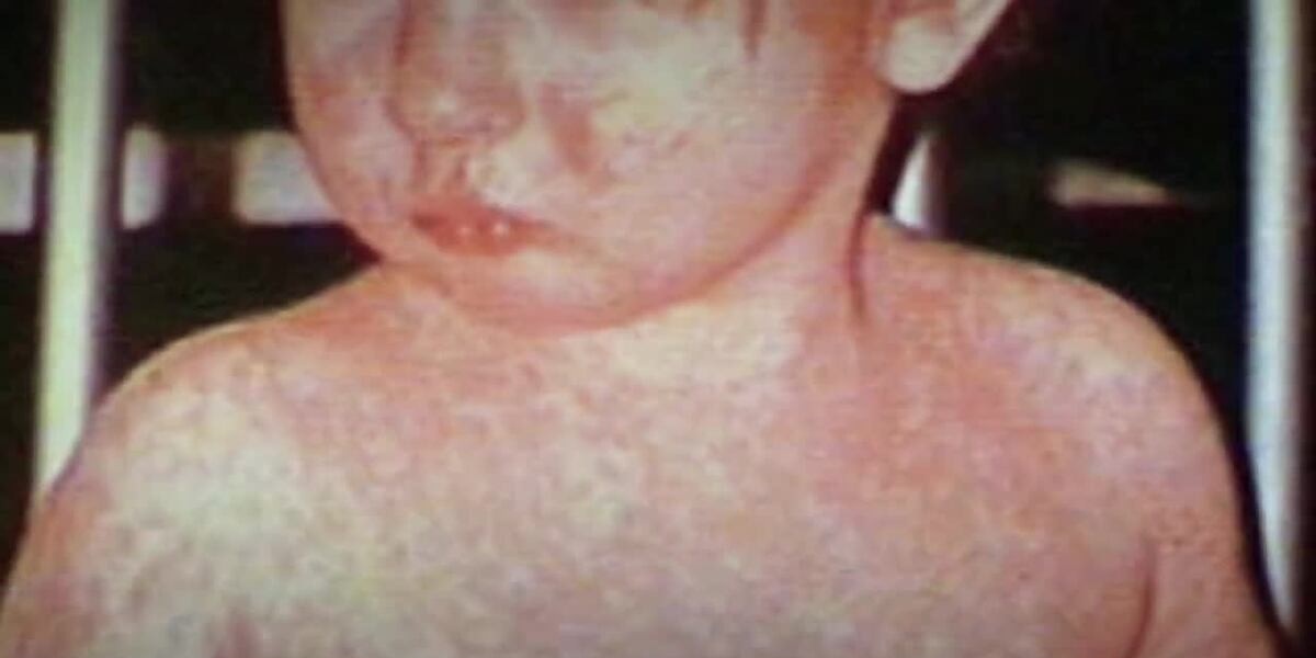 Nearly 900 measles cases reported in US as vax rates prompt endemic fears [Video]
