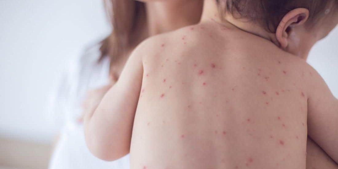Measles outbreak sees sharpest rise with 223 new infections in Ontario [Video]