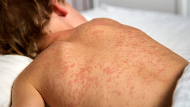 Measles jumps by 65 cases in Elgin and Oxford Counties, totalling above 1,200 across Ontario [Video]