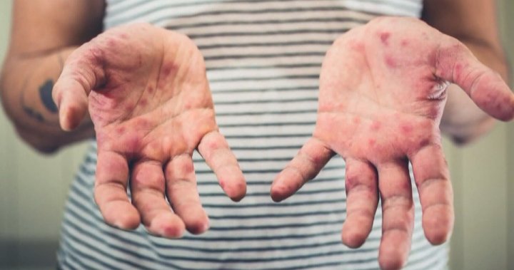 Alberta reports 17 more cases of measles, bringing total to more than 200 [Video]