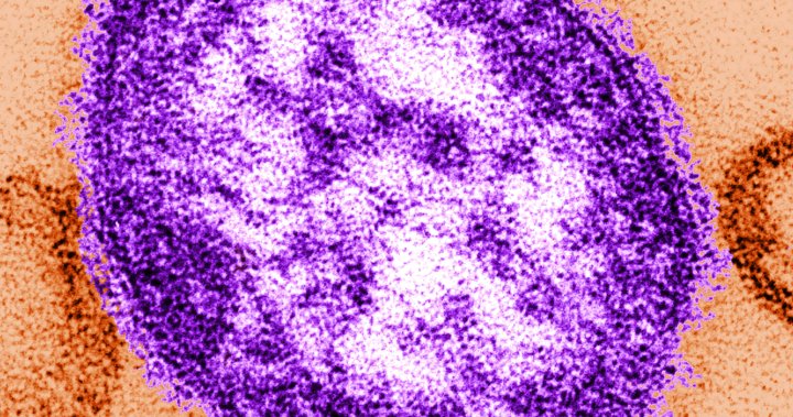 Measles exposure alert issued for communities south of Winnipeg - Winnipeg [Video]