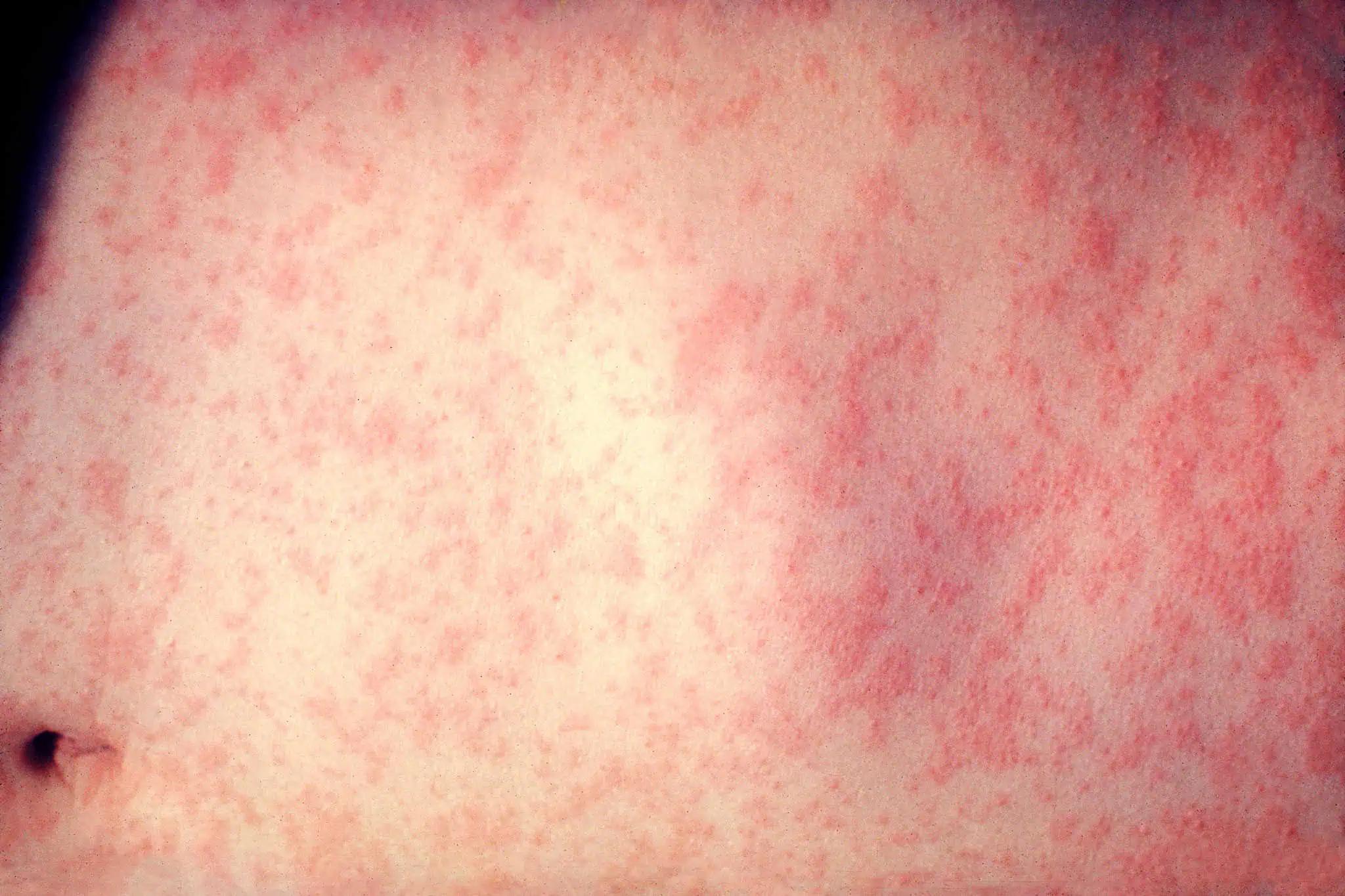 Possible measles exposure reported at Toronto Pearson Airport in Mississauga [Video]