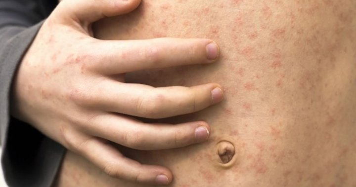 AHS warns of possible measles exposures in Taber, Whitecourt and Grimshaw [Video]