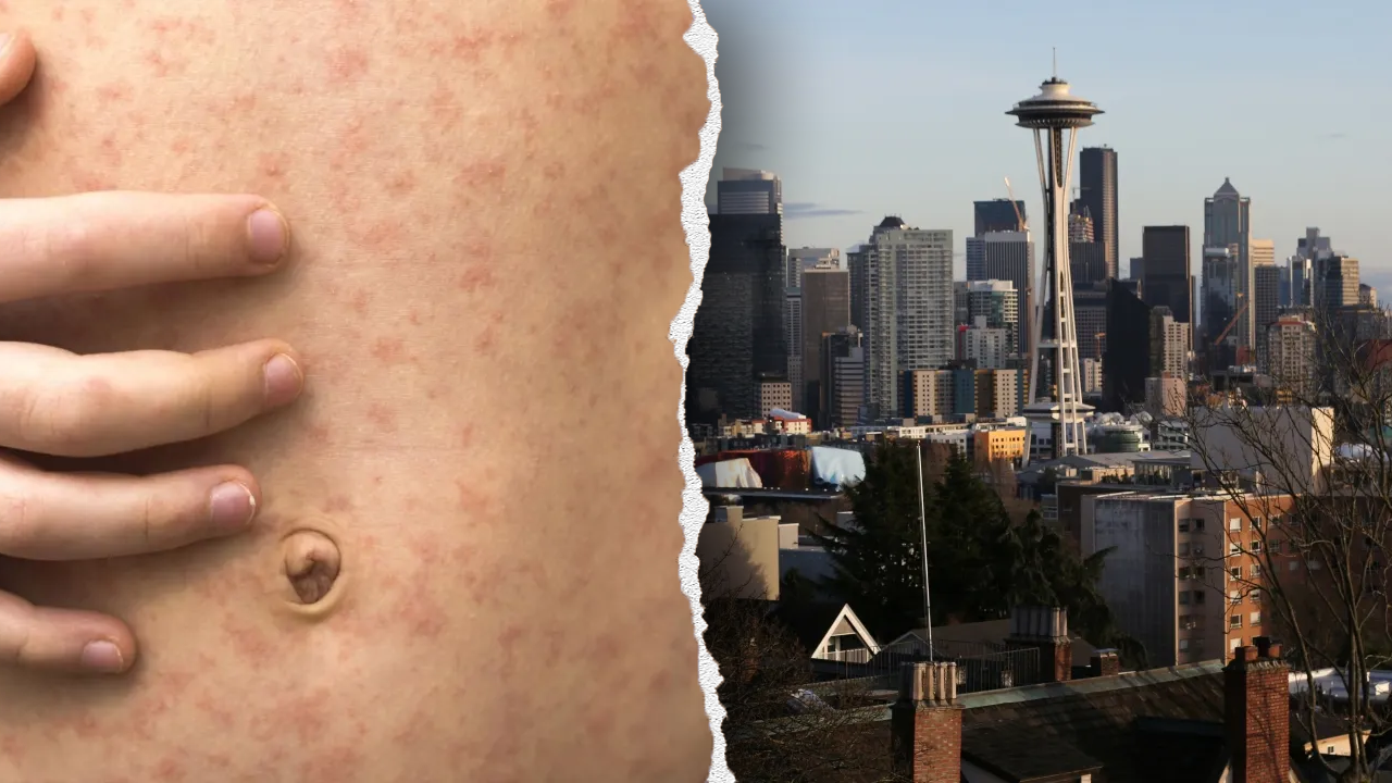 Measles exposure alert at Seattle airport after Canadian traveler visits Washington state [Video]