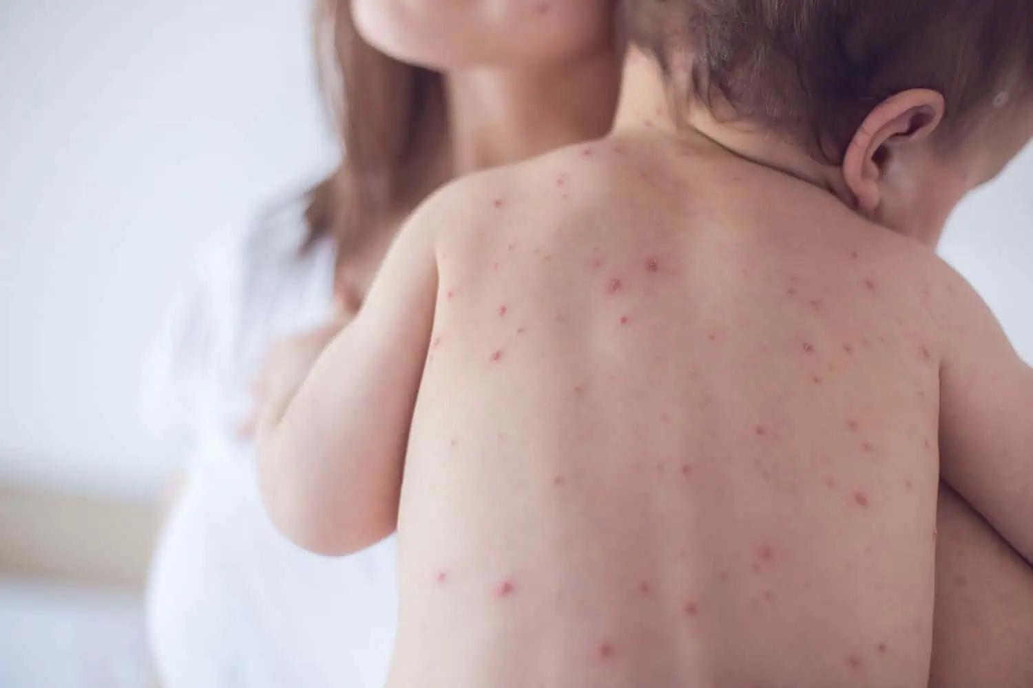 OUTBREAK: Measles cases among unvaccinated children on the rise in Ontario [Video]
