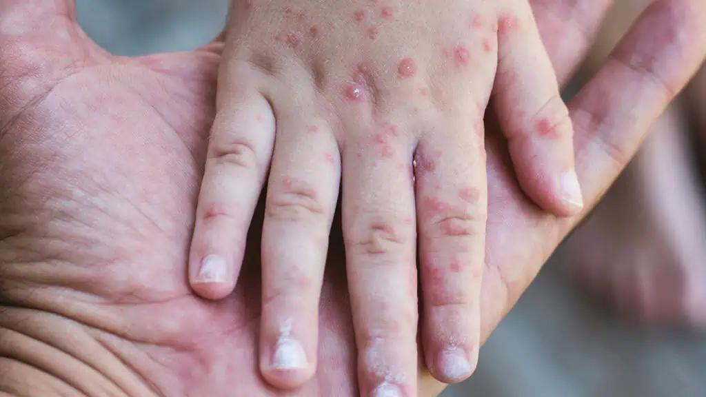 Measles exposure reported at restaurant and concert hall in Ontario [Video]