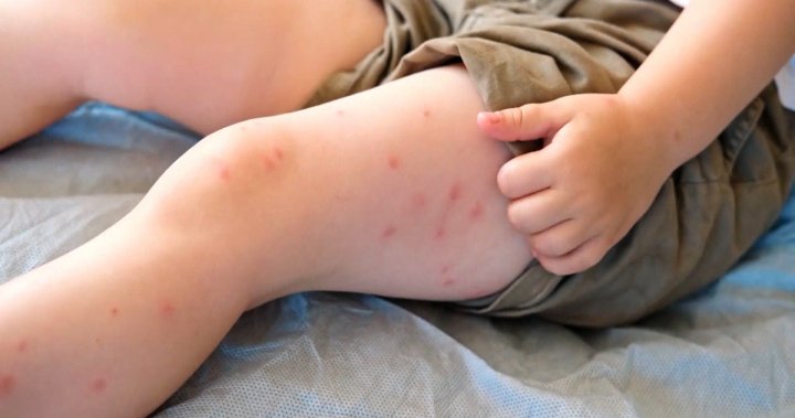Soaring number of Alberta measles cases worries health officials in both Canada, U.S. [Video]