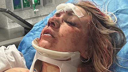 Astonishing wedding day transformation of bride who was beaten bloody in brutal bachelorette party attack [Video]