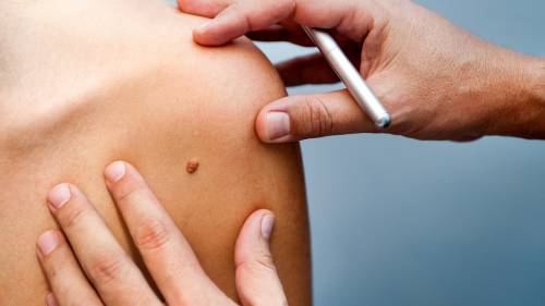 Melanoma cases surge as study links rise to poor sun safety habits in Canada [Video]