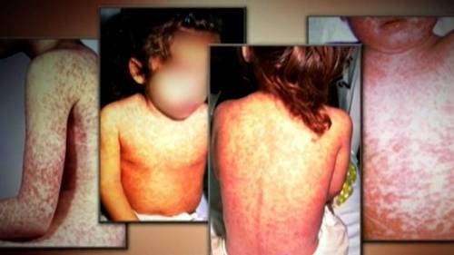 Health Matters: Doctor discusses measles, ticks, sunscreen and more [Video]
