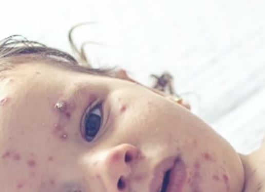 Alberta reports 48 new cases of measles over the Victoria Day long weekend [Video]
