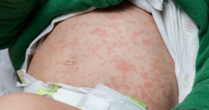 Alberta reports 19 new cases of measles, surpassing 500 confirmed infections [Video]