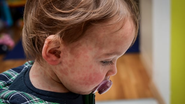 Parents of babies worry about measles exposure in Manitoba outbreak [Video]